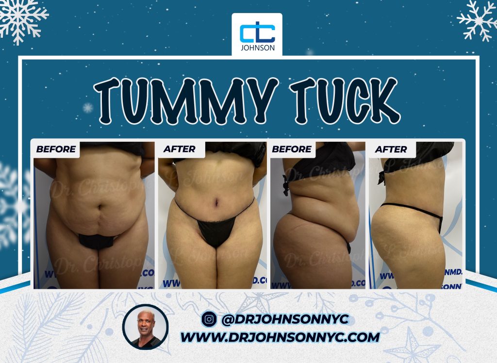 Abdominoplasty before-and-after result 7