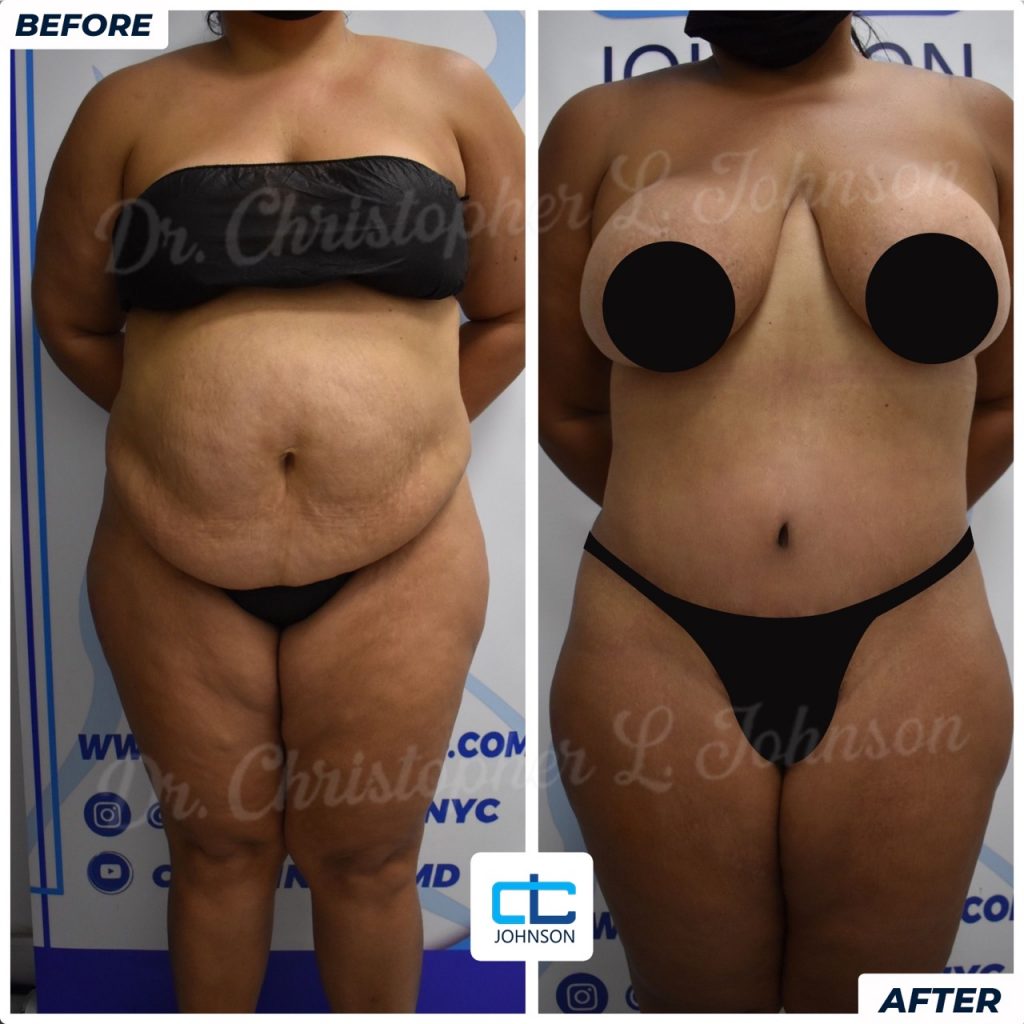 Abdominoplasty before-and-after result 1