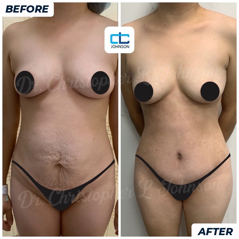 Abdominoplasty before-and-after result 2