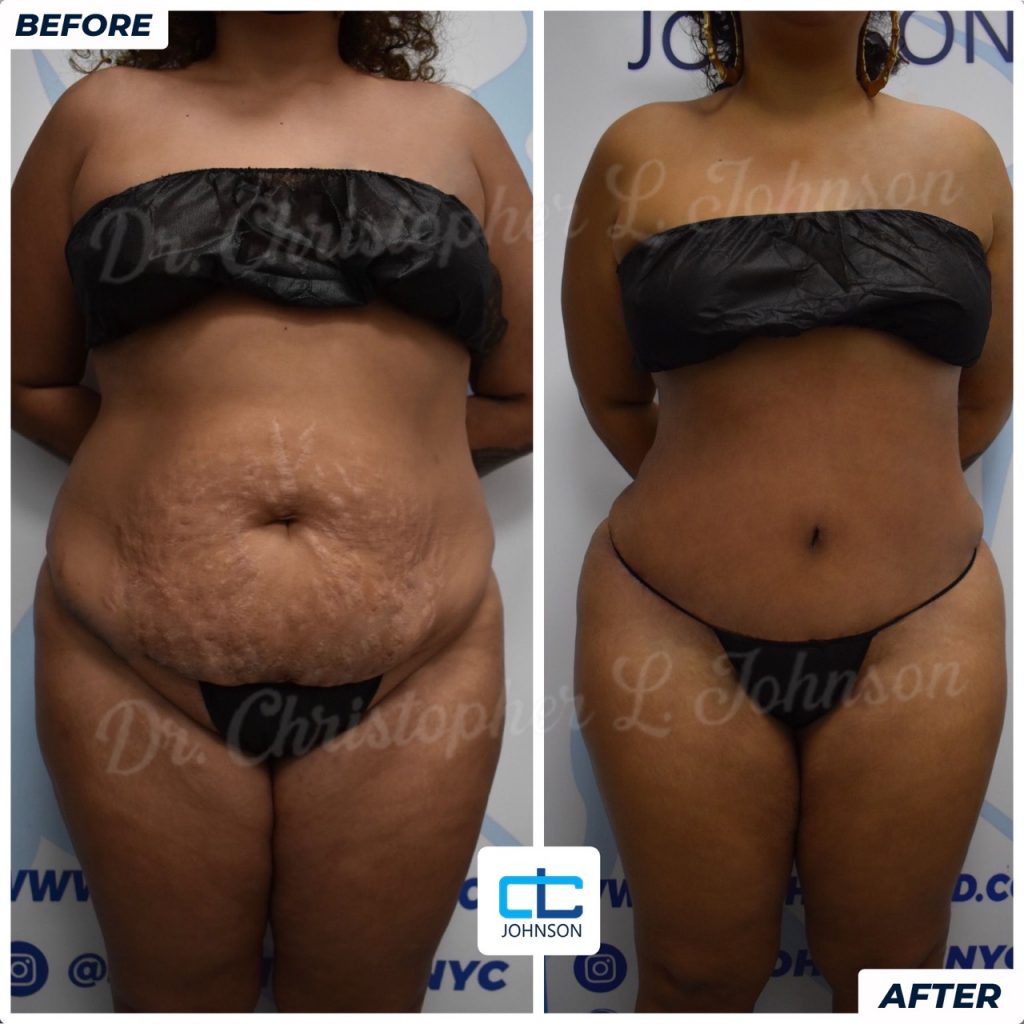 Abdominoplasty before-and-after result 3