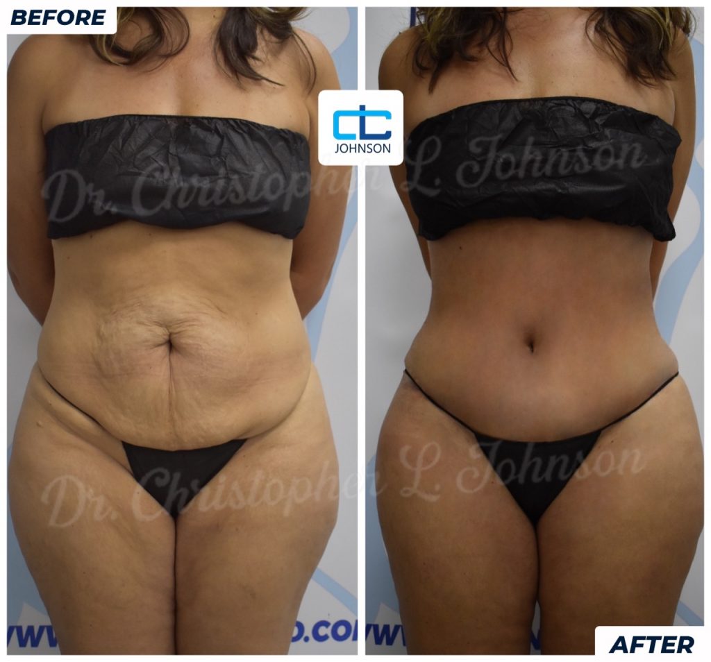 Abdominoplasty before-and-after result 4