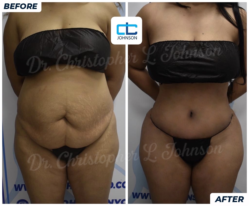 Abdominoplasty before-and-after result 5