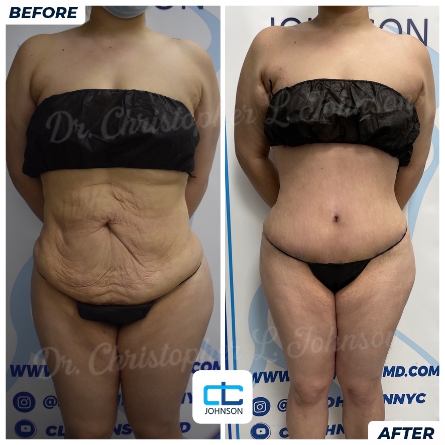 Abdominoplasty before-and-after result 6