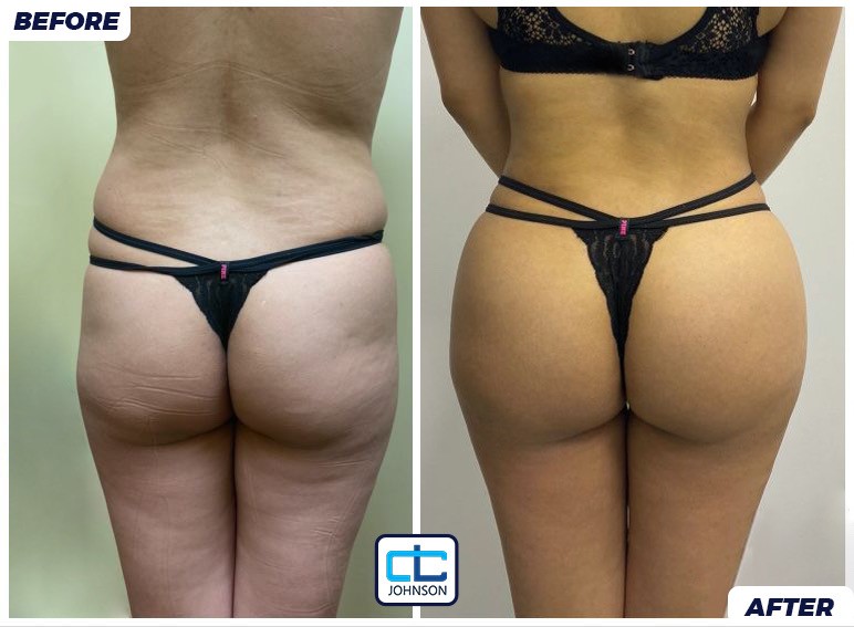 Brazilian Butt Lift before-and-after result 1