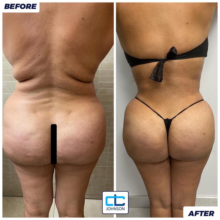 Brazilian Butt Lift before-and-after result 2