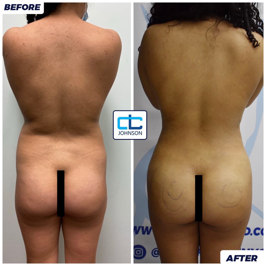 Brazilian Butt Lift before-and-after result 3