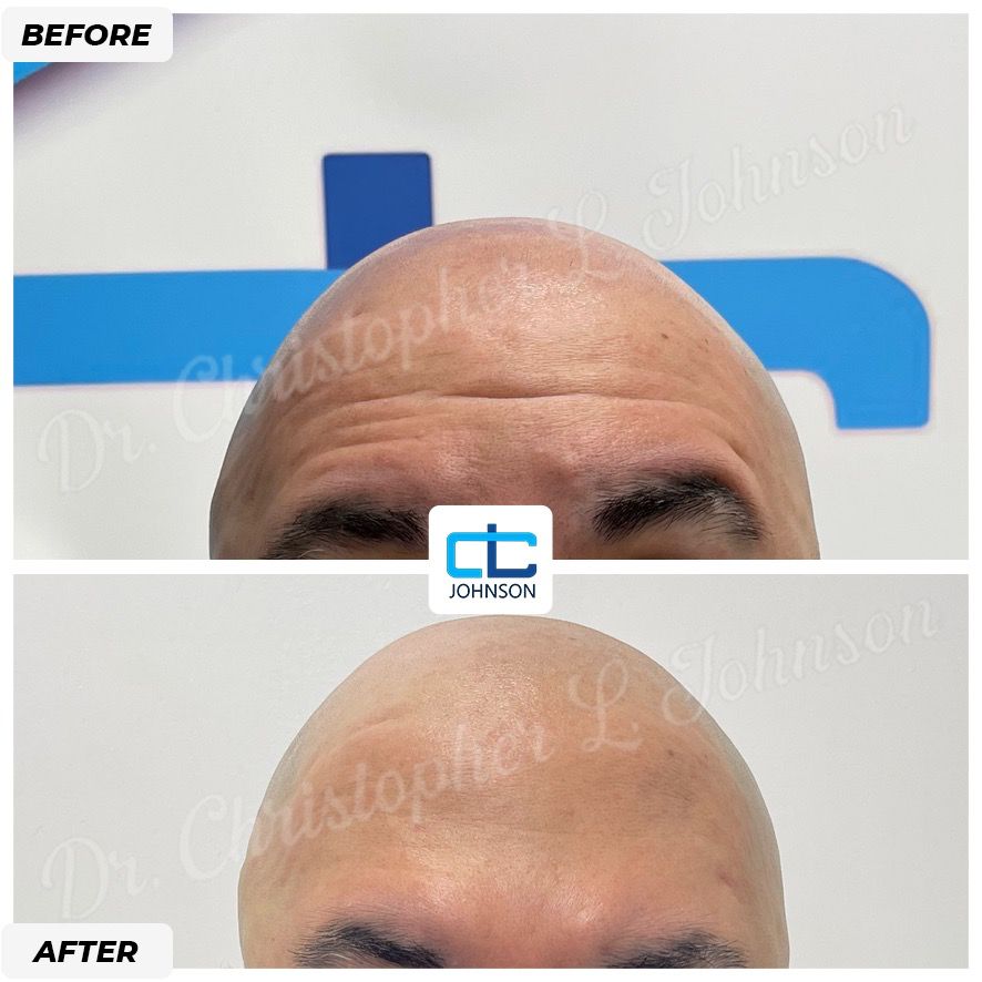 Blepharoplasty before-and-after result 2