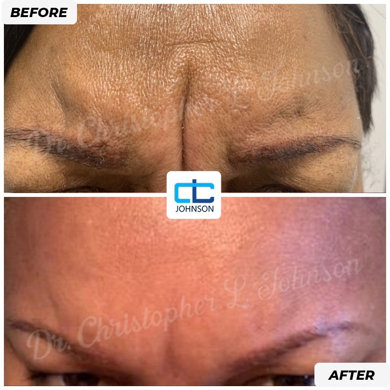 Blepharoplasty before-and-after result 3