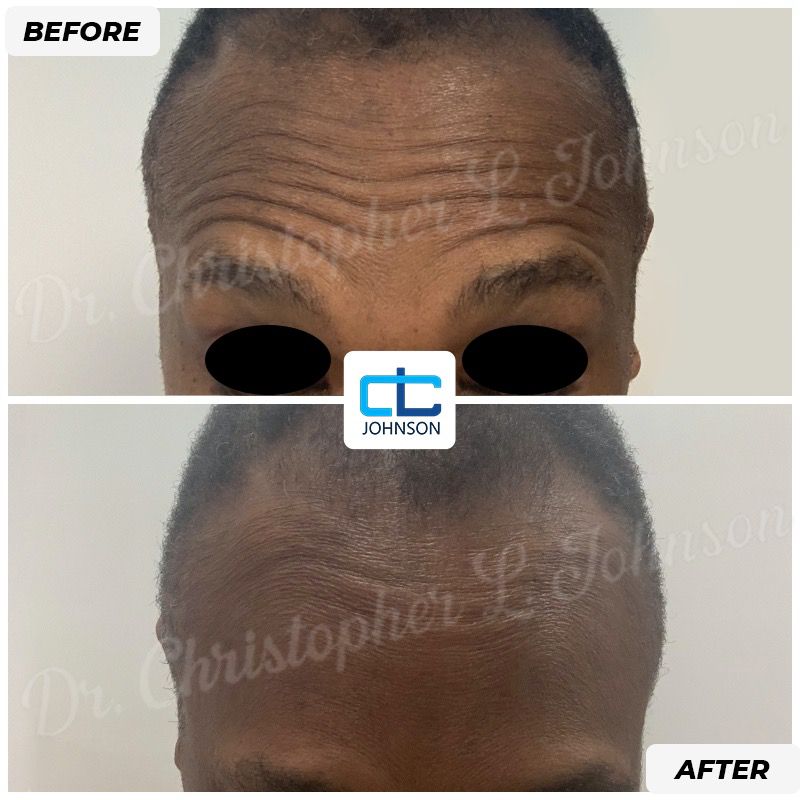 Botox® before-and-after result 1