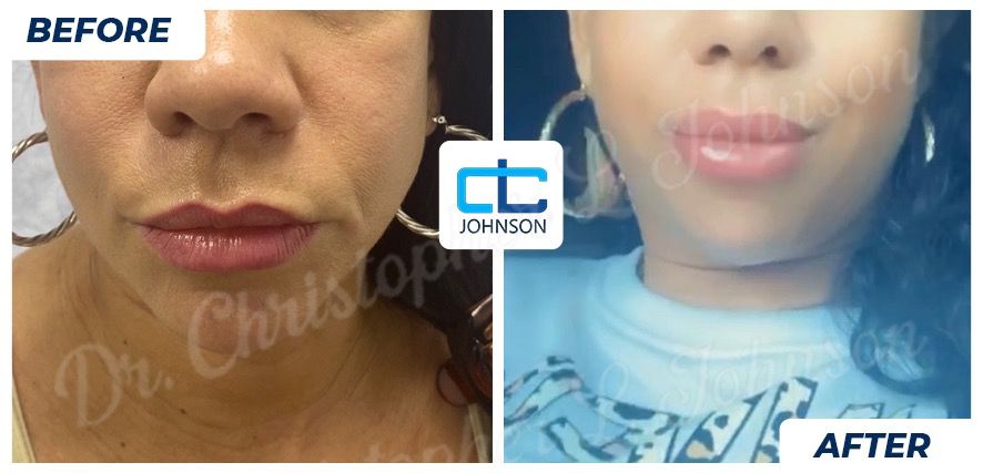 Lip Augmentation before-and-after result 1