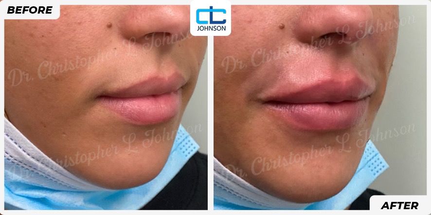 Lip Augmentation before-and-after result 2