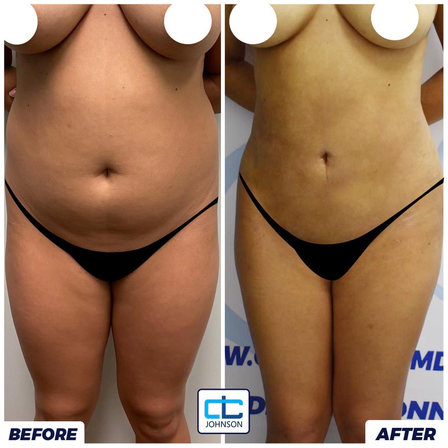 Liposuction before-and-after result 1