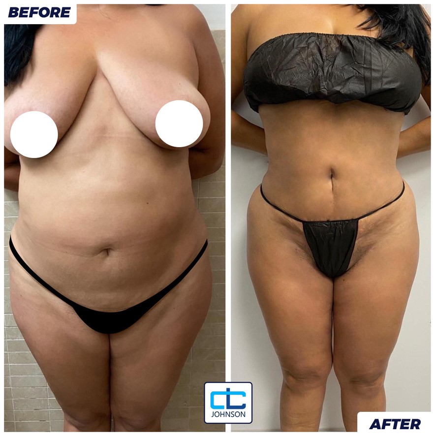 Liposuction before-and-after result 2
