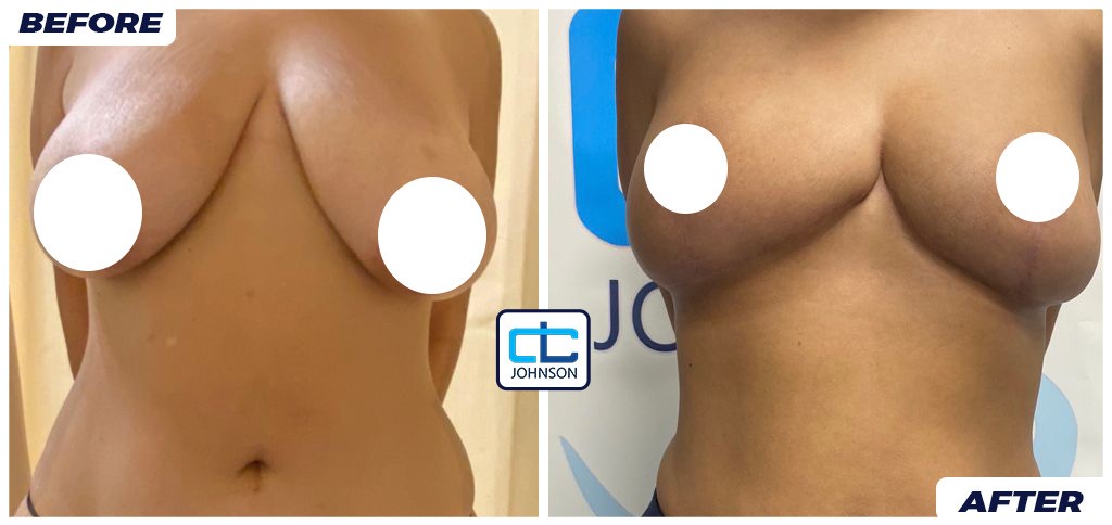 Mammoplasty before-and-after result 1