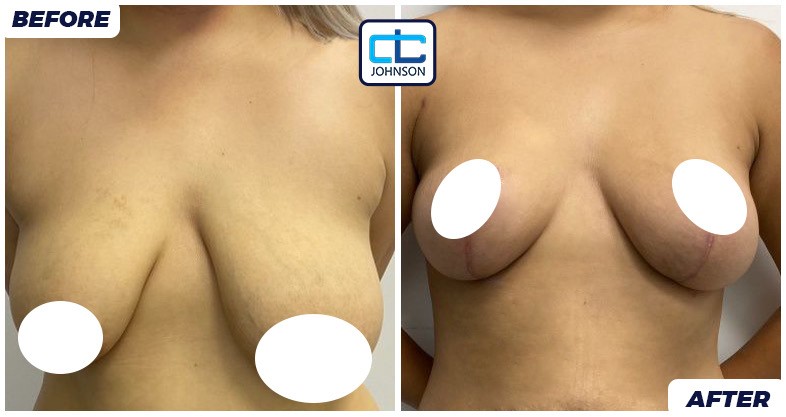 Mammoplasty before-and-after result 4