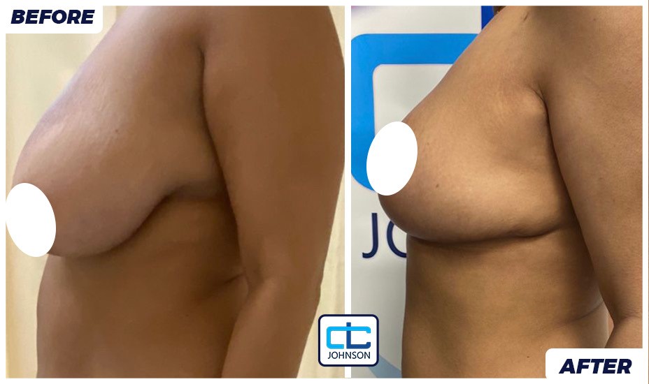Mammoplasty before-and-after result 2