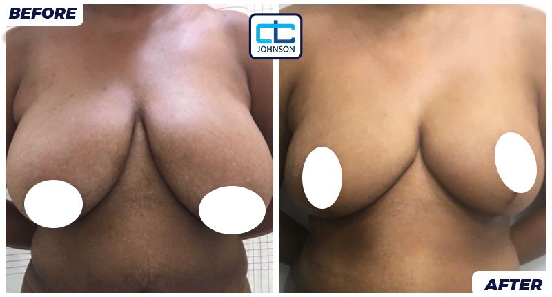 Mammoplasty before-and-after result 3