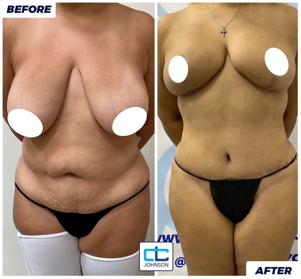 Mommy Makeover before-and-after result 1