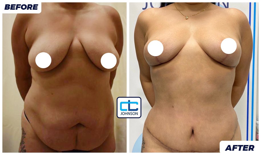 Mommy Makeover before-and-after result 2