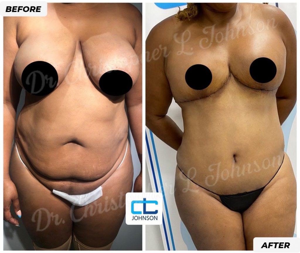 Mommy Makeover before-and-after result 3