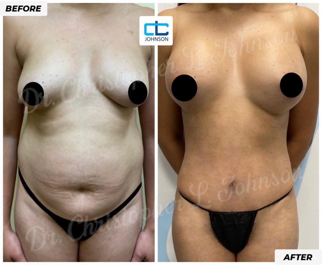 Mommy Makeover before-and-after result 4