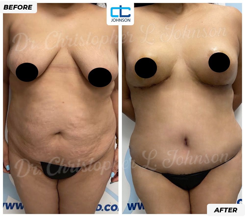 Mommy Makeover before-and-after result 5