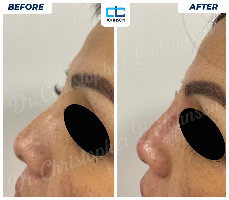 Non-Surgical Rhinoplasty before-and-after result 1