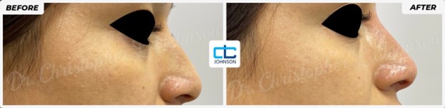 Non-Surgical Rhinoplasty before-and-after result 2